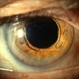 Anterior Chamber Intraocular Lens Anterior Chamber Intraocular Lens